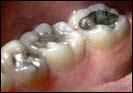 Amalgam fillings